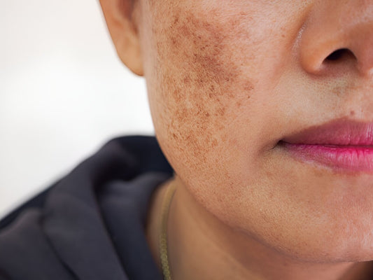 Hyperpigmentation And Melasma