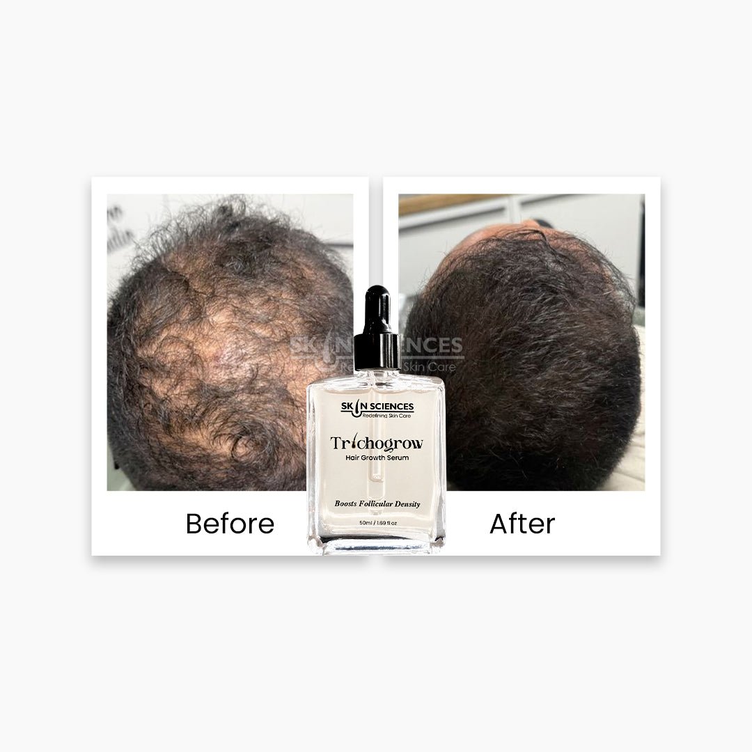 Trichogrow Serum - Hair Growth Serum - Skin Sciences